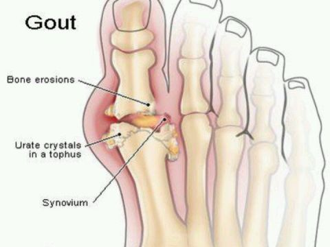 che do an uong kieng ki cho nguoi bi mac benh gout Chế độ ăn uống, kiêng kị cho người bị mắc bệnh Gout