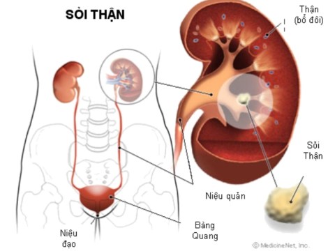 che do an uong kieng ki cho nguoi bi mac benh soi than Chế độ ăn uống, kiêng kị cho người bị mắc bệnh sỏi thận