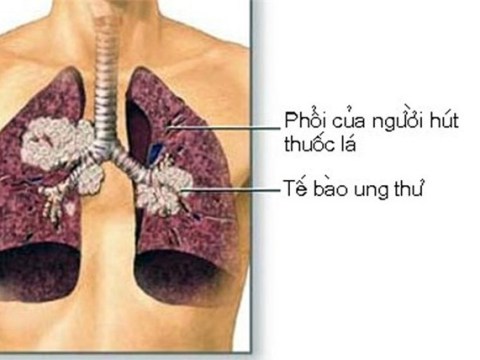 che do an uong kieng ki cho nguoi bi mac benh ung thu phoi Chế độ ăn uống, kiêng kị cho người bị mắc bệnh ung thư phổi