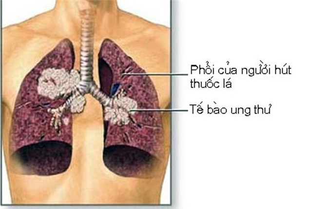 Chế độ ăn uống, kiêng kị cho người bị mắc bệnh ung thư phổi