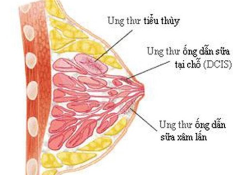 che do an uong kieng ki cho nguoi bi mac benh ung thu vu Chế độ ăn uống, kiêng kị cho người bị mắc bệnh ung thư vú