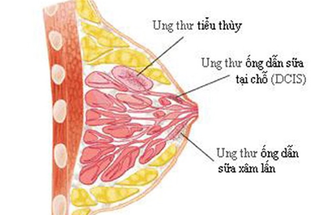 Chế độ ăn uống, kiêng kị cho người bị mắc bệnh ung thư vú