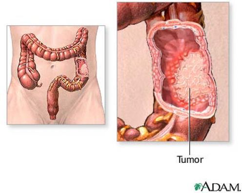 Chế độ ăn uống, kiêng kị cho người bị mắc bệnh Viêm đại tràng